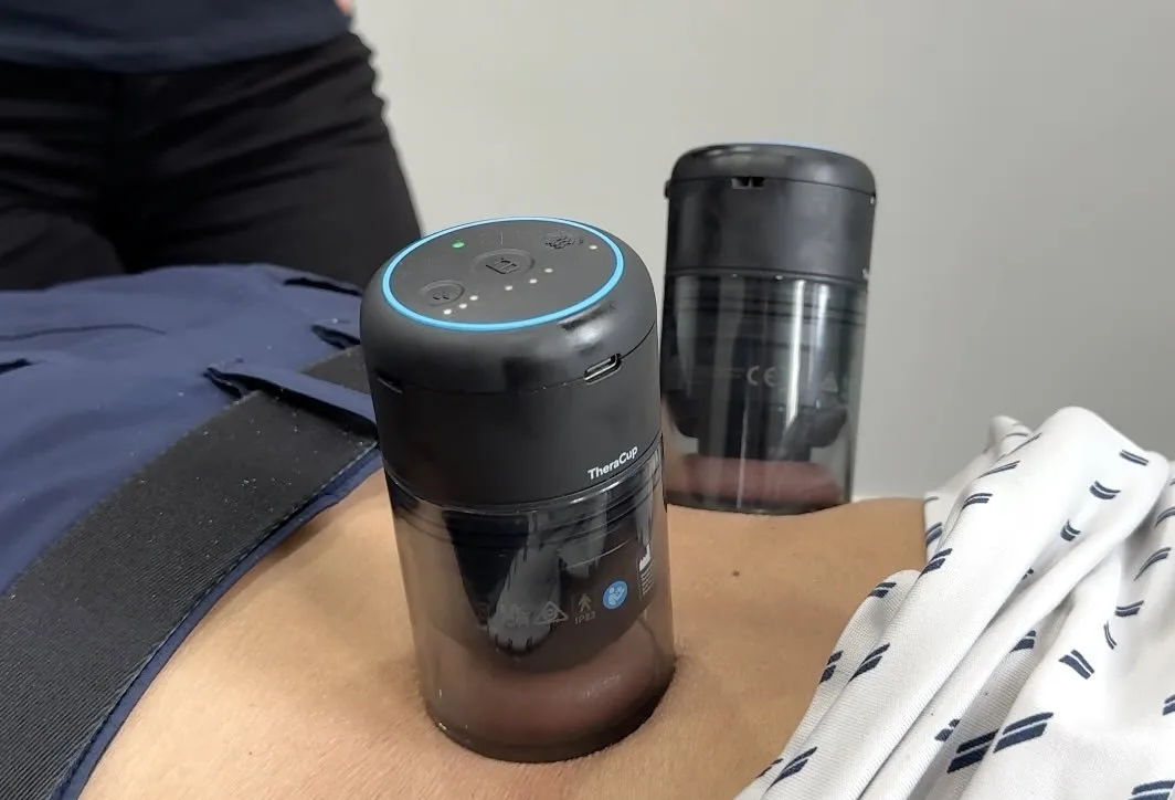 Cupping therapy on a patient's back